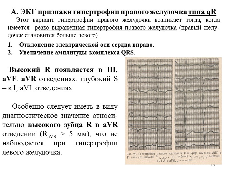 74 А. ЭКГ признаки гипертрофии правого желудочка типа qR 74 А. ЭКГ признаки гипертрофии правого желудочка типа qR